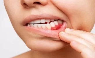 Diş eti çekilmesi diş kaybı ile sonuçlanabilir!